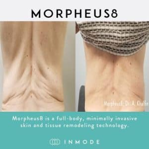 Morpheus8-treatment-miami