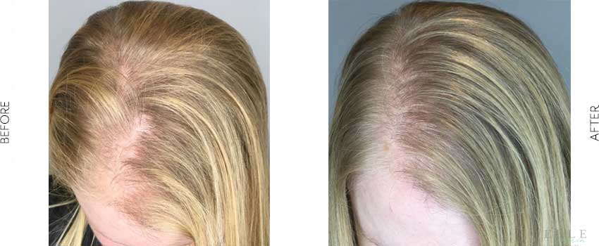 Hair-restoration-with-PRP
