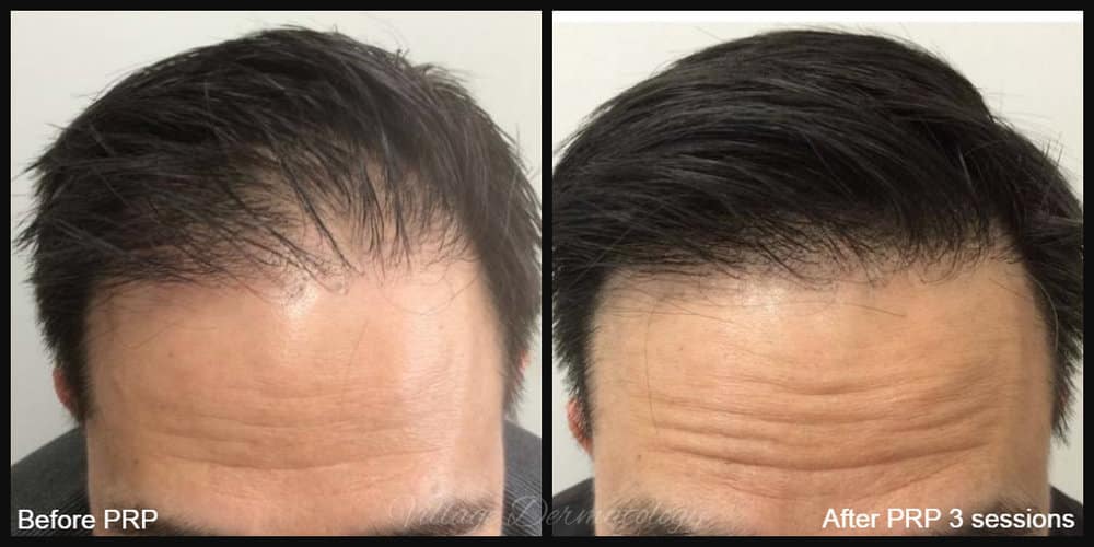 PRP-hair-restoration