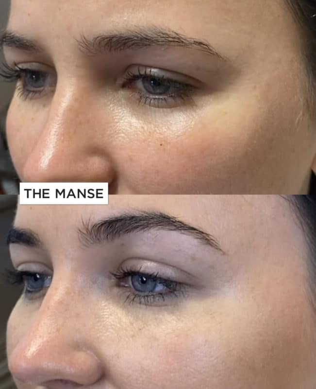 before-and-after-browlift