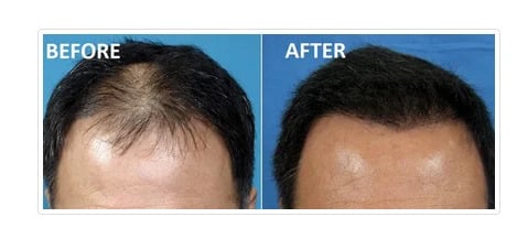 stem-cell-hair-regrowth-treatment